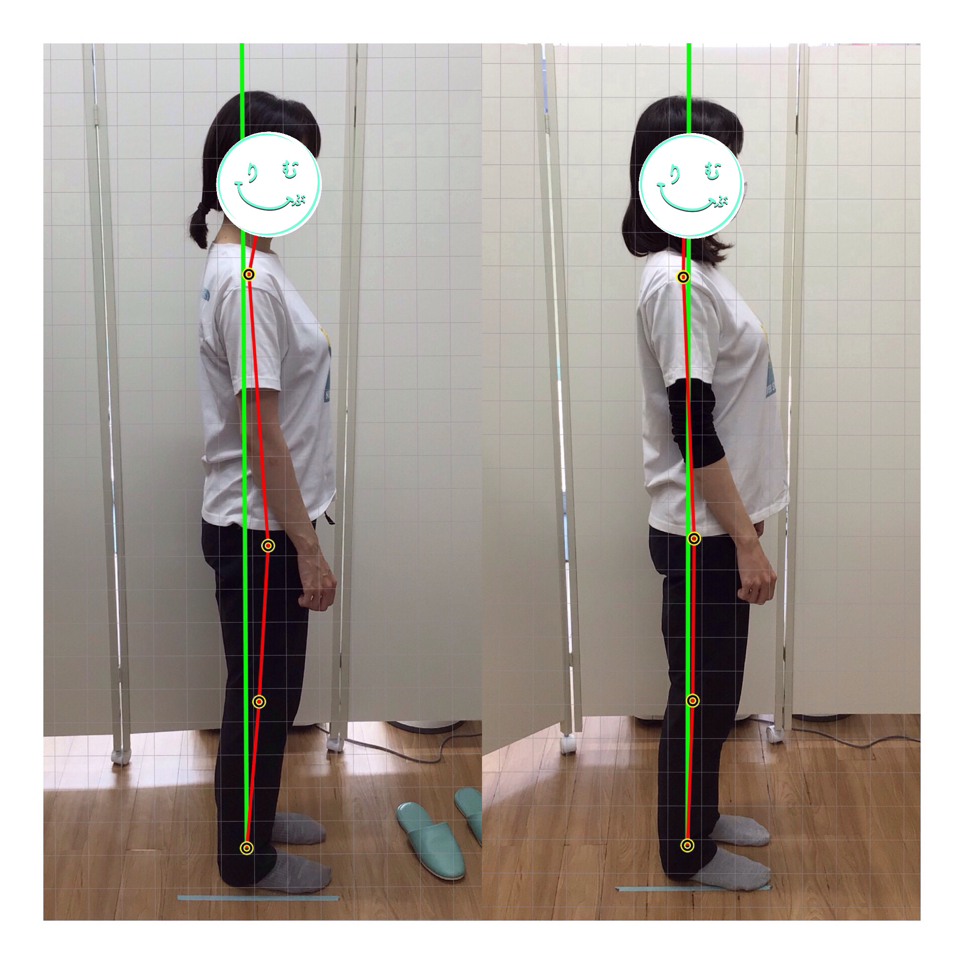 ビフォーアフター⑤側面・前傾姿勢改善